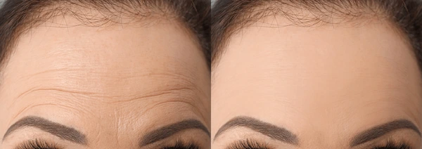 Forehead Lines Treatment